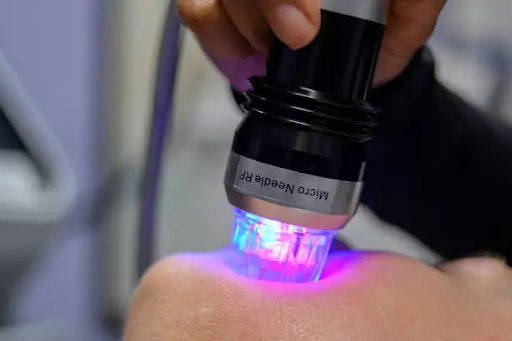 RF Microneedling Before and After: What To Expect And How It Transforms Skin RF Microneedling